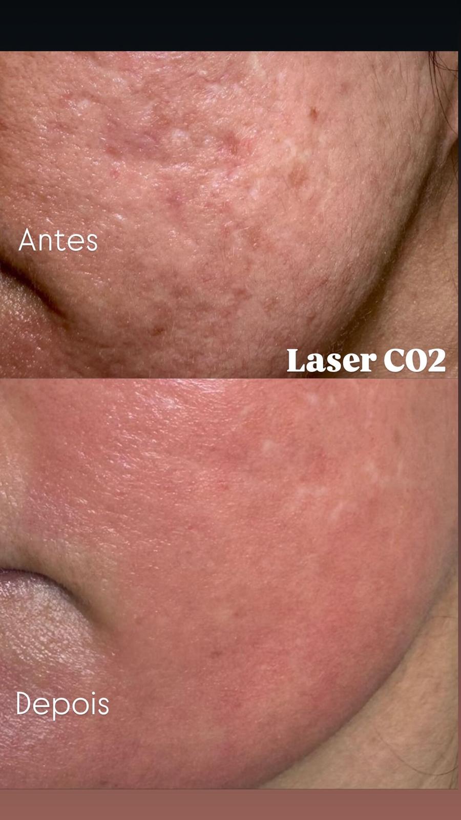 Laser CO₂