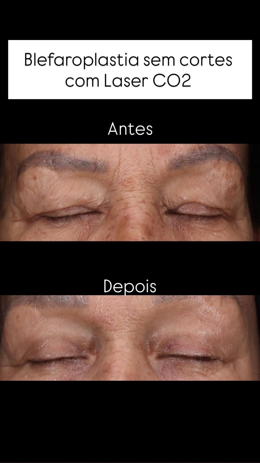 Blefaroplastia s/ Cortes