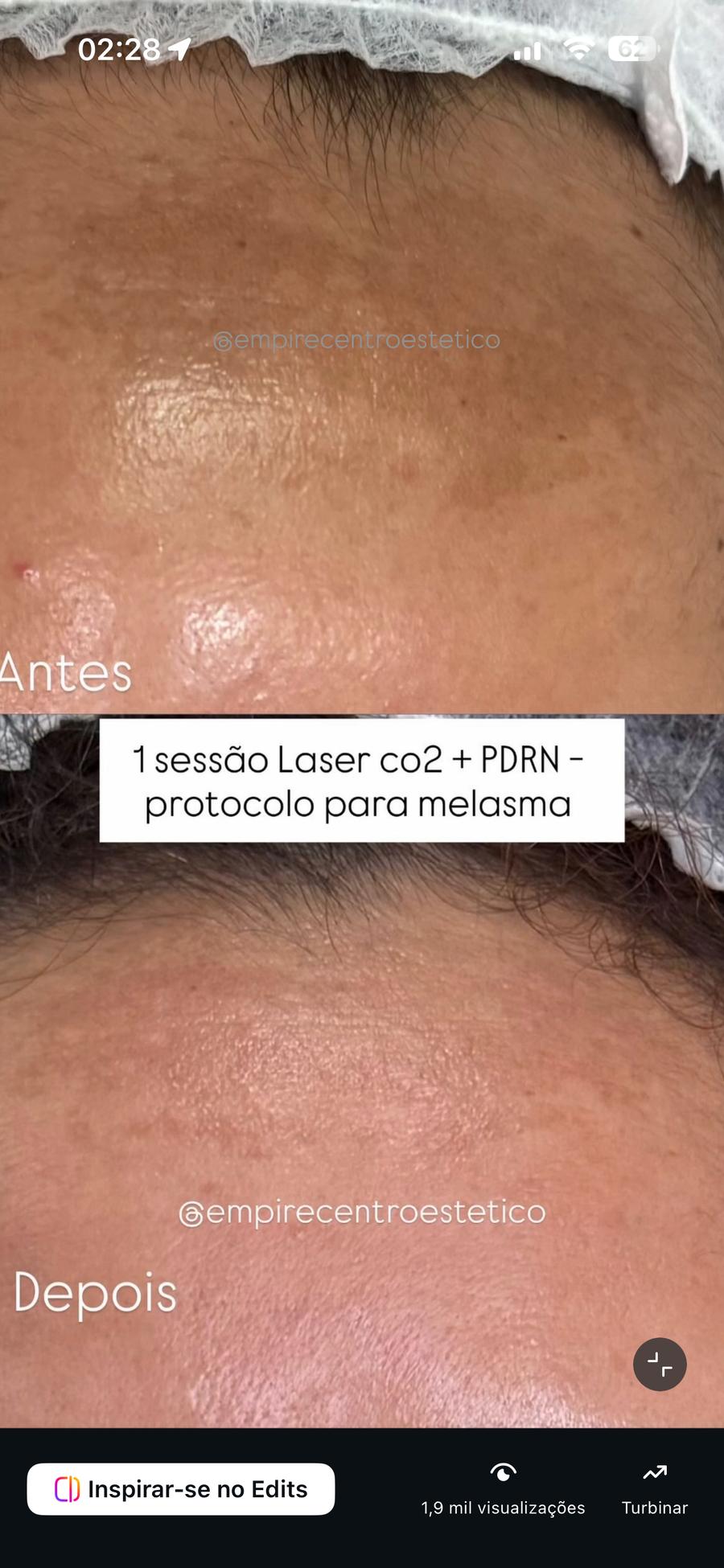 Laser CO₂ + PDRN