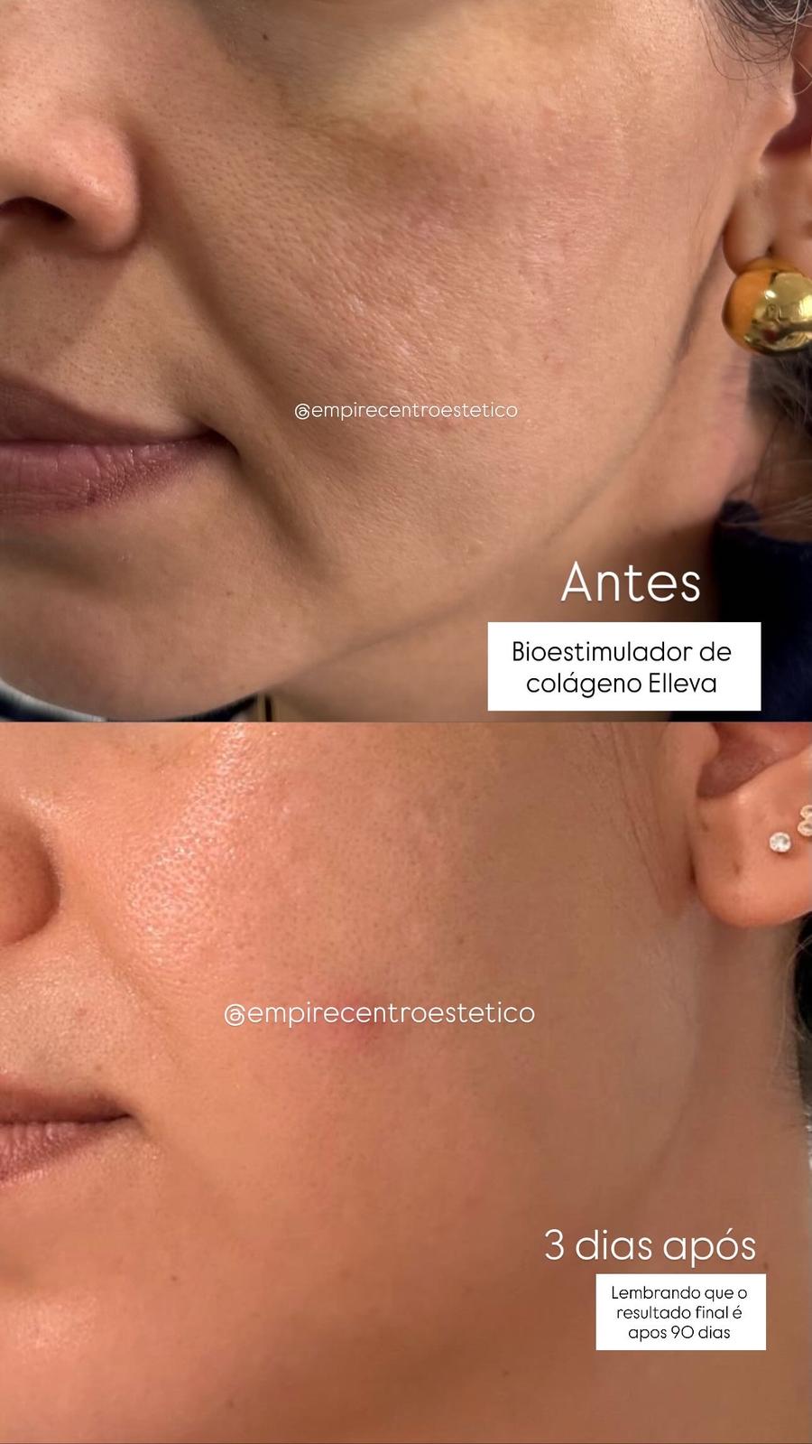 Bioestimulador Elleva