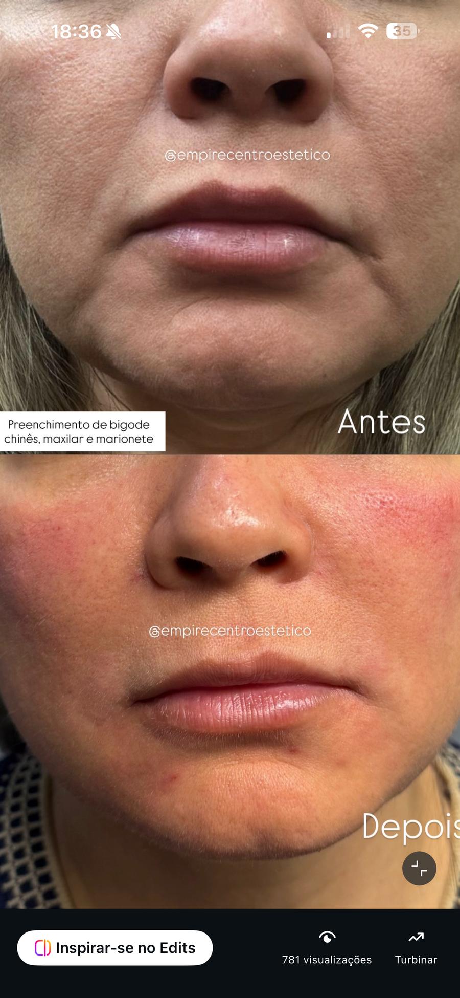 Preenchimento Facial