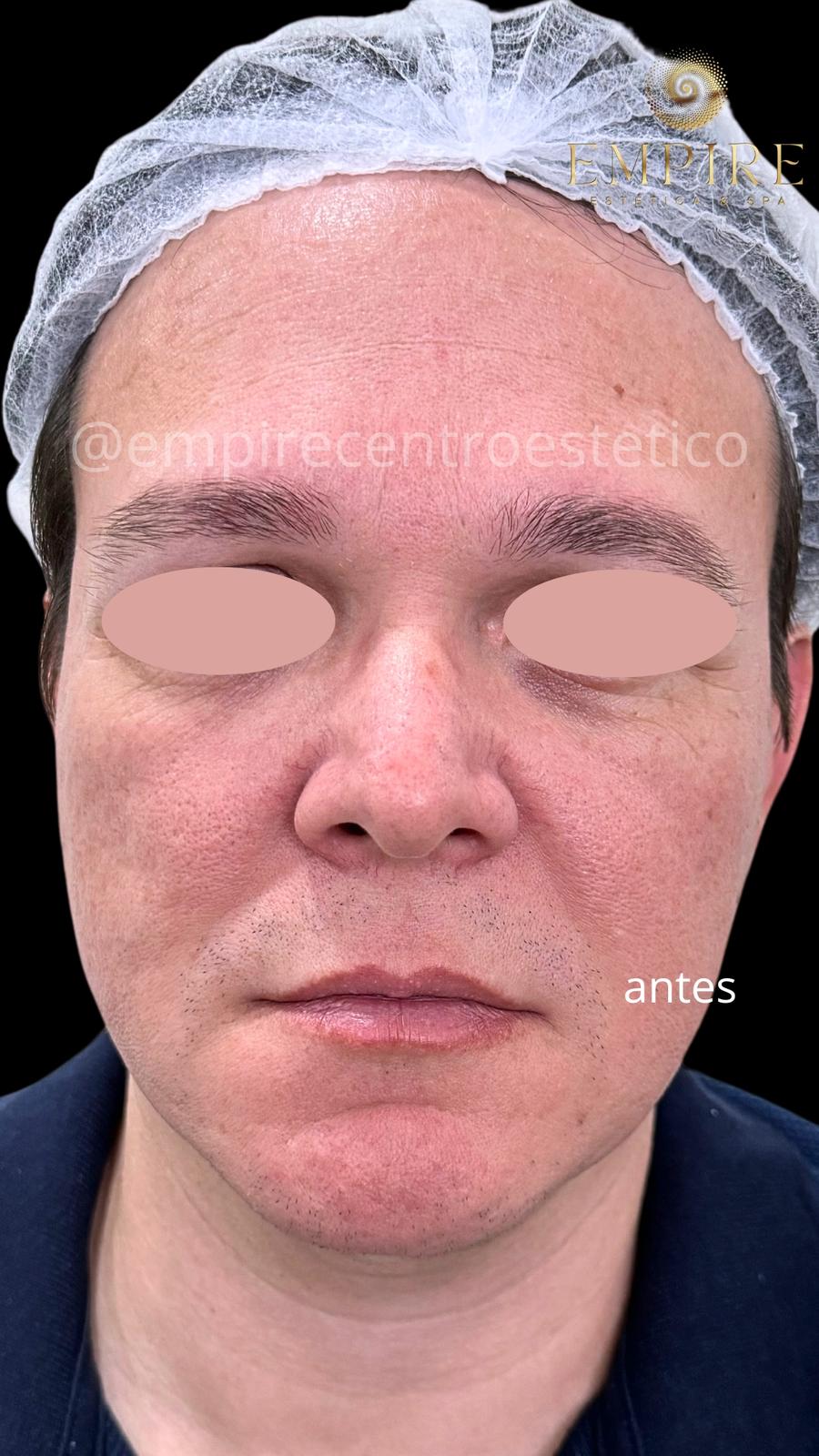 Antes