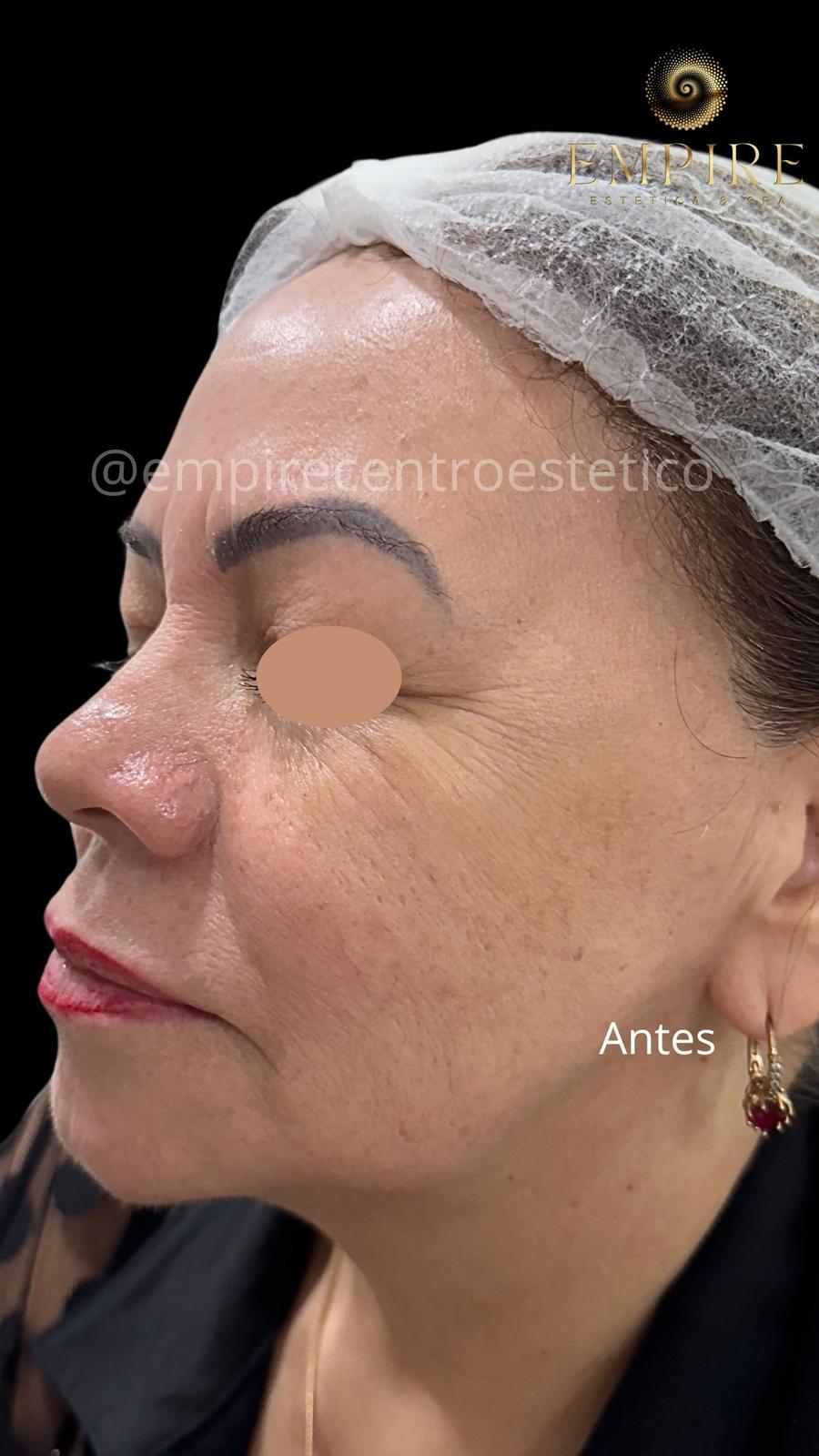 Antes